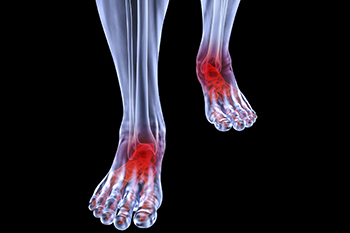 arthritic foot care in the Plymouth County, MA: Plymouth (Kingston, Duxbury, Marshfield, Pembroke, Hanson, Halifax, Middleborough, Carver, Bridgewater, Lakeville) areas