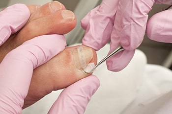 ingrown toenail treatment in the Plymouth County, MA: Plymouth (Kingston, Duxbury, Marshfield, Pembroke, Hanson, Halifax, Middleborough, Carver, Bridgewater, Lakeville) areas