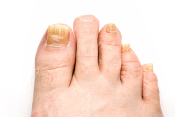 Fungal toenails  treatment in the Plymouth County, MA: Plymouth (Kingston, Duxbury, Marshfield, Pembroke, Hanson, Halifax, Middleborough, Carver, Bridgewater, Lakeville) areas